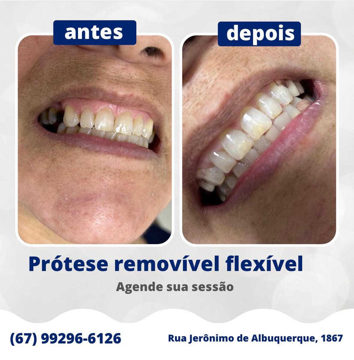 Antes e depois de prótese removível flexível